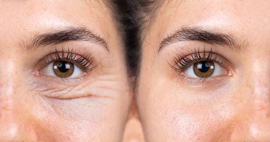 How to Combat Eye Wrinkles